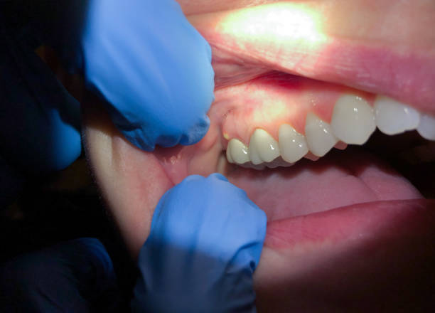 Best Dentist for Tooth Abscess  in Girard, OH