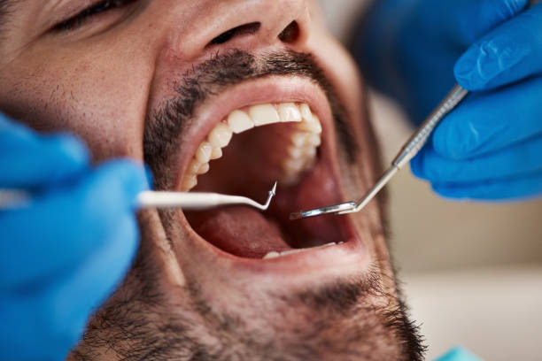 Best Chipped Tooth Repair Near Me  in Girard, OH